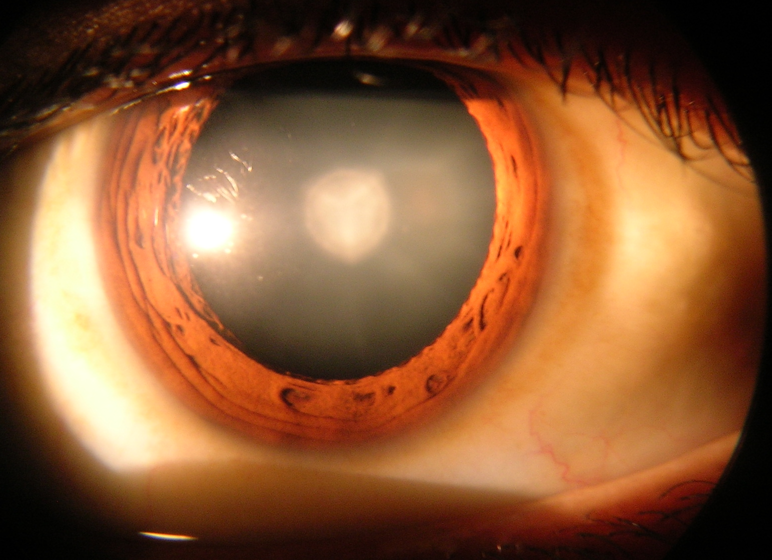 Imagine reprezentativa pentru Cataracta: simptome, diagnostic si optiuni de tratament
