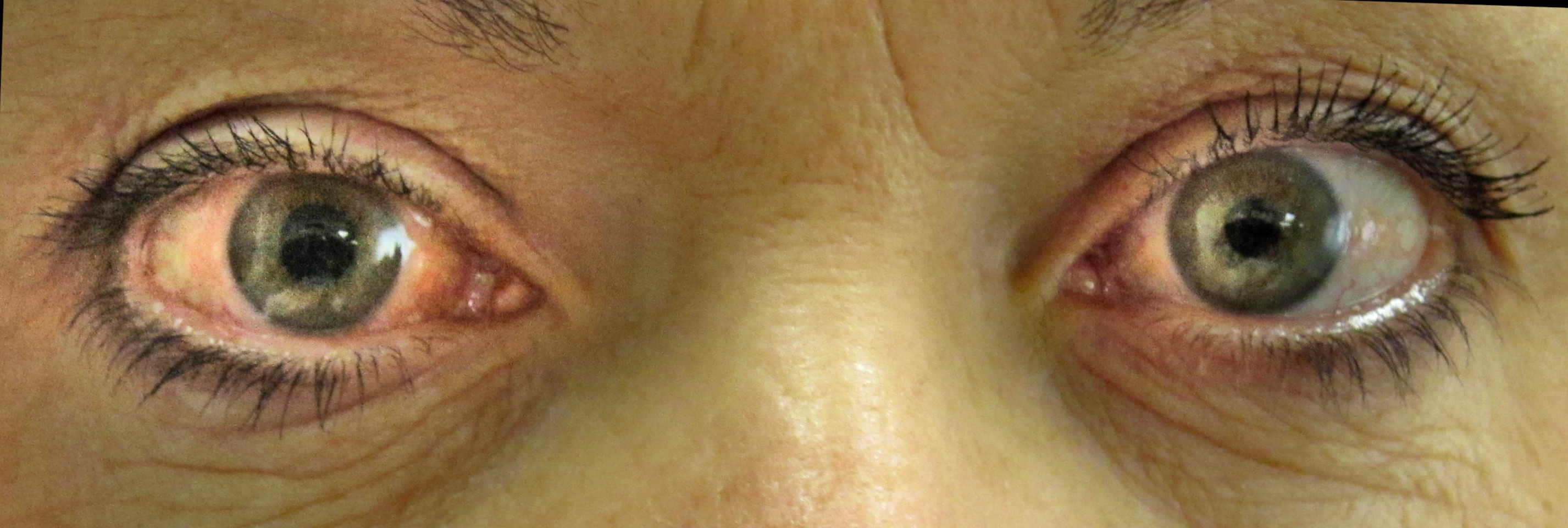 Imagine reprezentativa pentru Glaucomul: de ce controalele periodice sunt esentiale